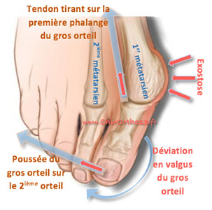 hallux valgus sport orthese